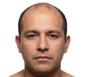 Alopecia androgenética