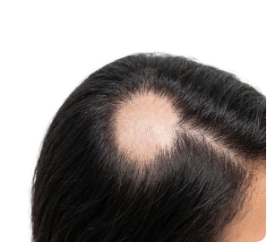 Alopecia areata