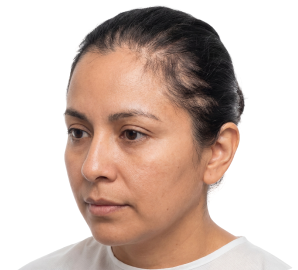 Alopecias por tracción