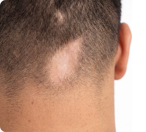 Alopecia cicatricial