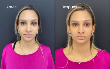 Testimonio de Alejandra Narváez en especialidad Rejuvenecimiento facial