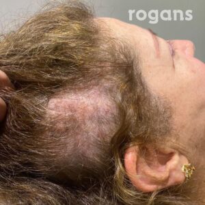 Alopecia Areata
