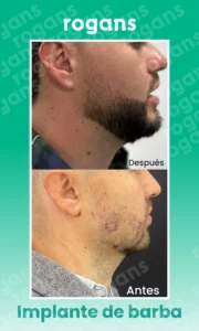 Implante de barba