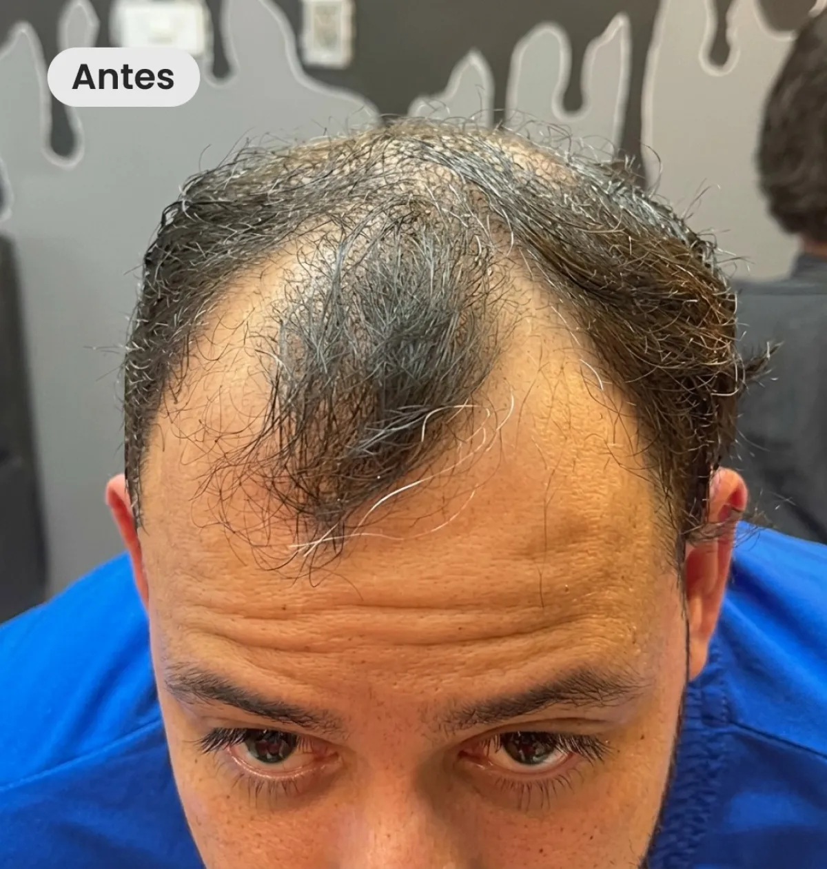 Antes del implante capilar