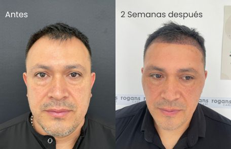 Testimonio de Martín en especialidad Restauración capilar